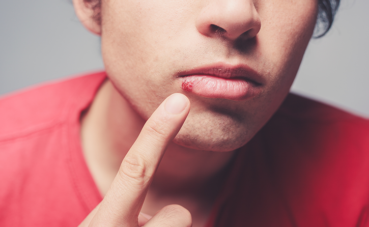 Treatment for Mouth Ulcers in London