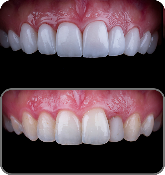 Veneers cost in London – Smile Clinic London
