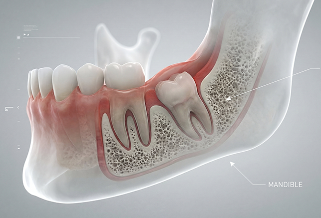 What Are the Procedure During Wisdom Teeth Extraction in London.