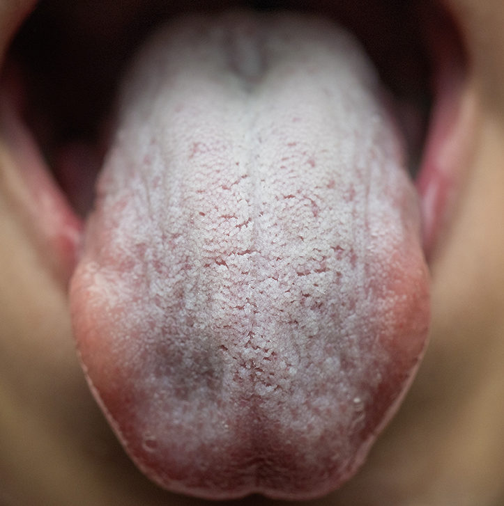 What Causes Dry Mouth in the UK