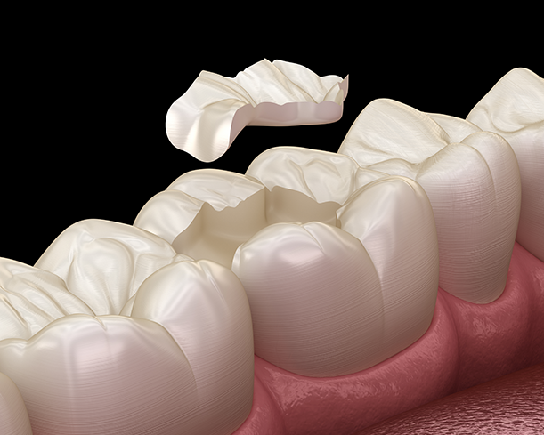 Inlays Treatment at Smile Clinic London
