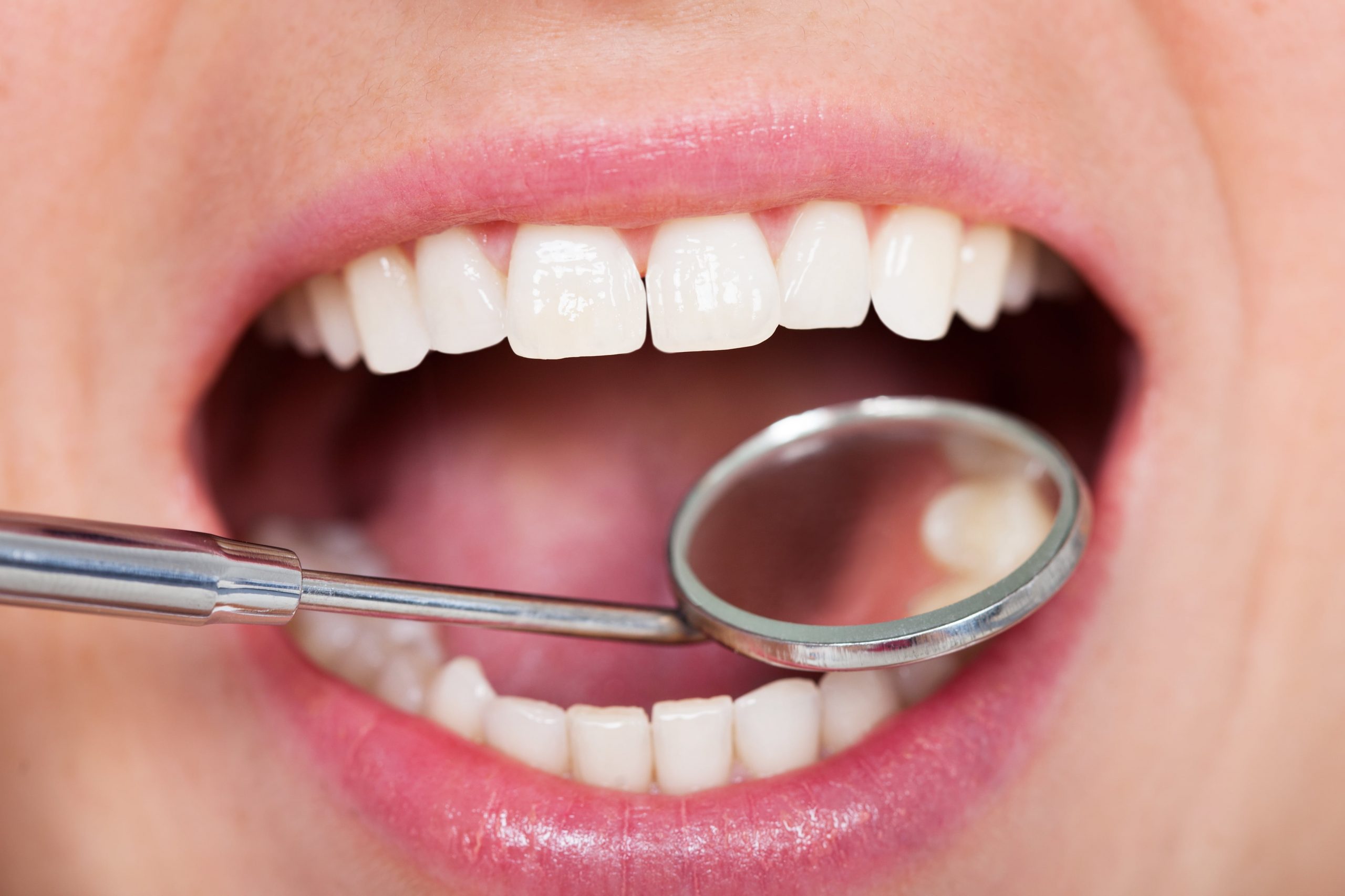 What are the perks of white fillings?