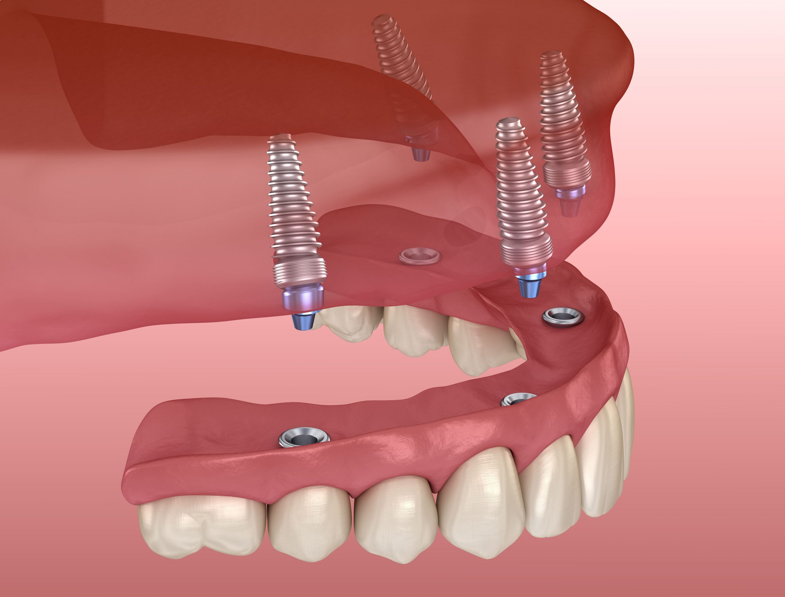 Advantages of All On 4 Dental Implants