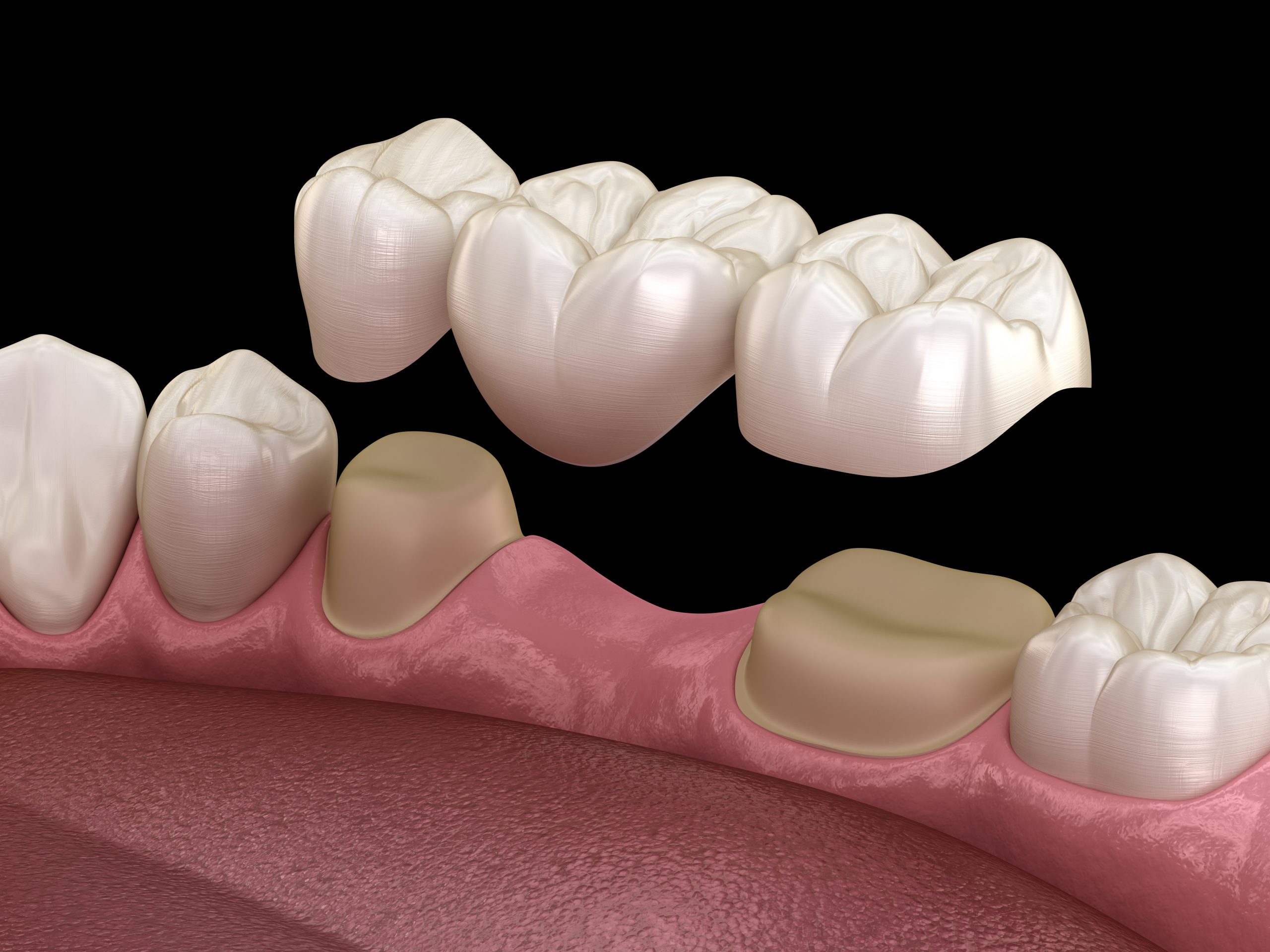 Alternatives to dental bridges