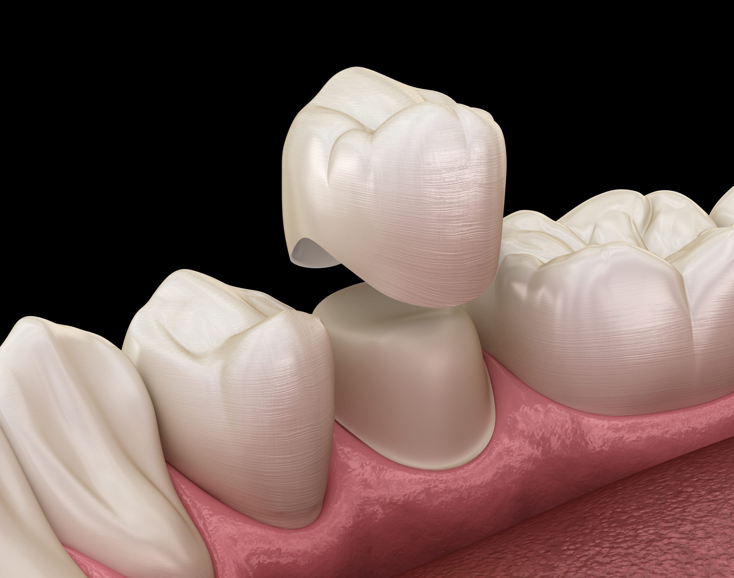 Disadvantages of dental crowns