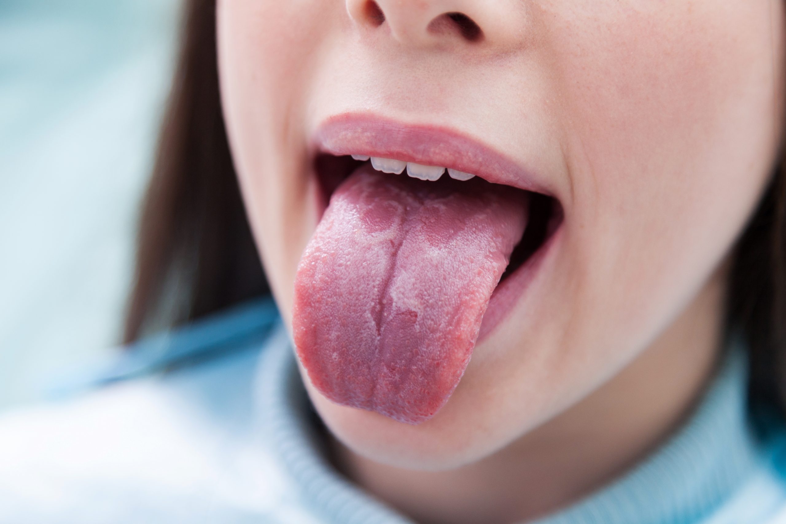 Geographic Tongue Symptoms