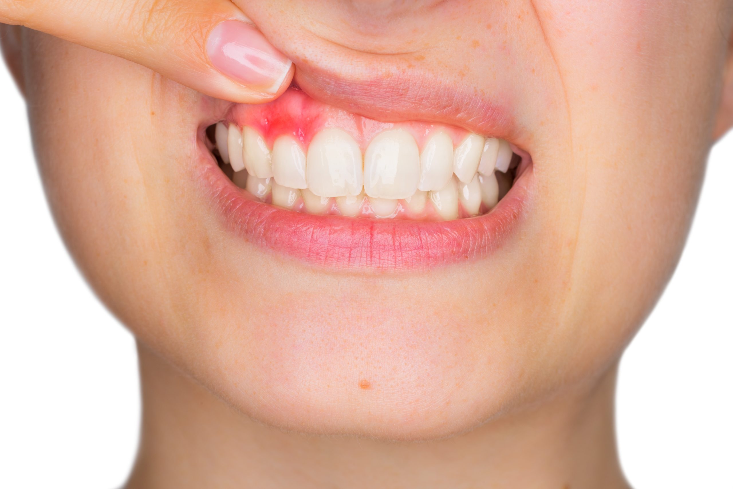 Risk Factors Of The Tooth Abscess 