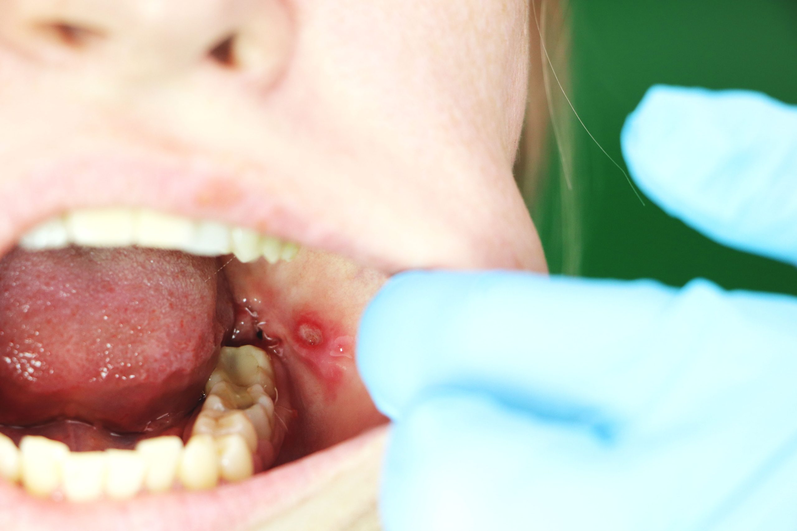 Mouth Ulcers Symptoms