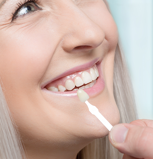 Indirect composite veneers