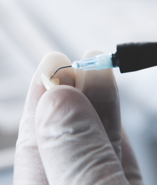 Composite Veneers London