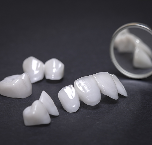 Indirect composite veneers